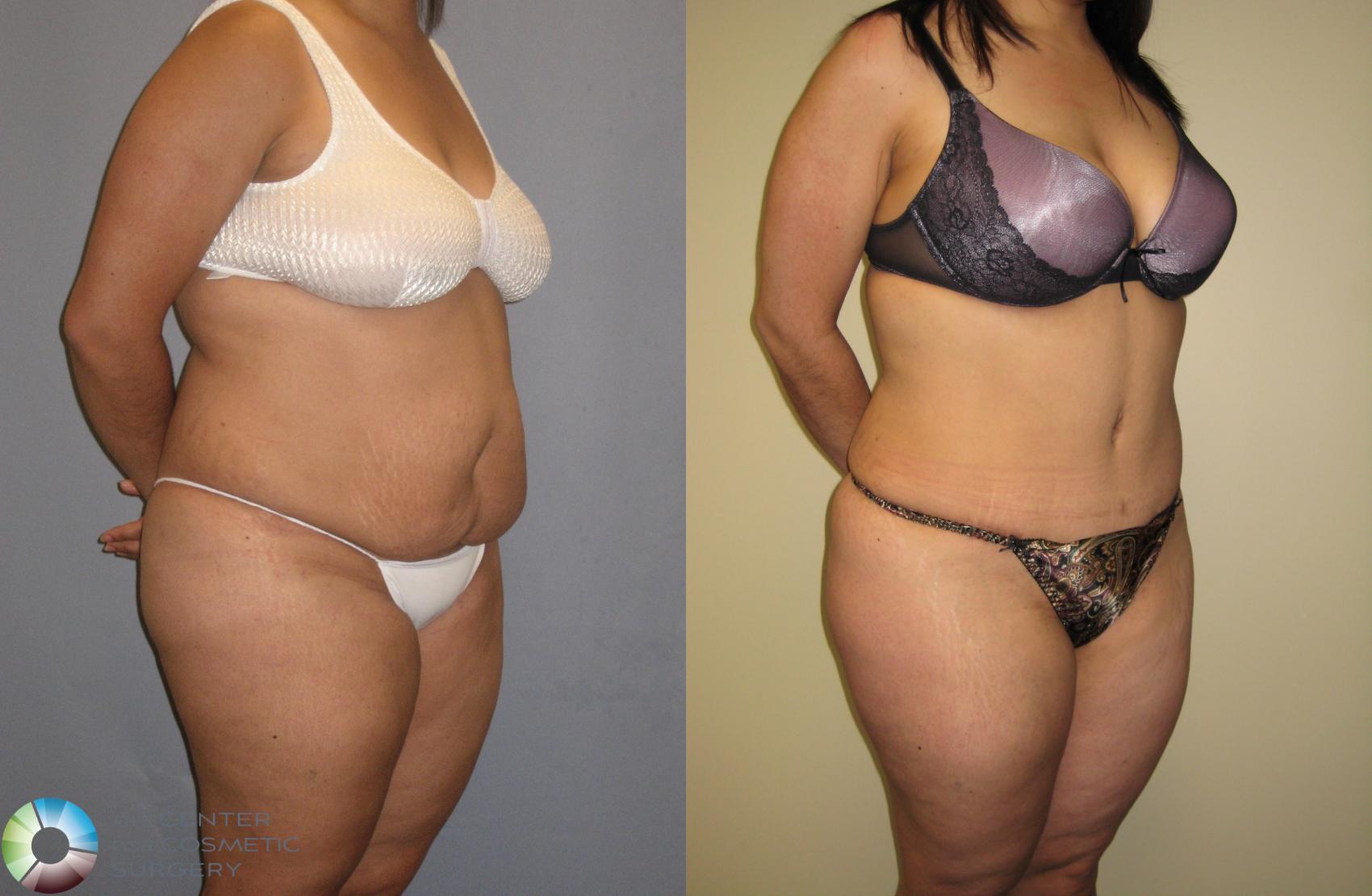 Before & After Tummy Tuck Case 160 View #3 View in Golden, CO