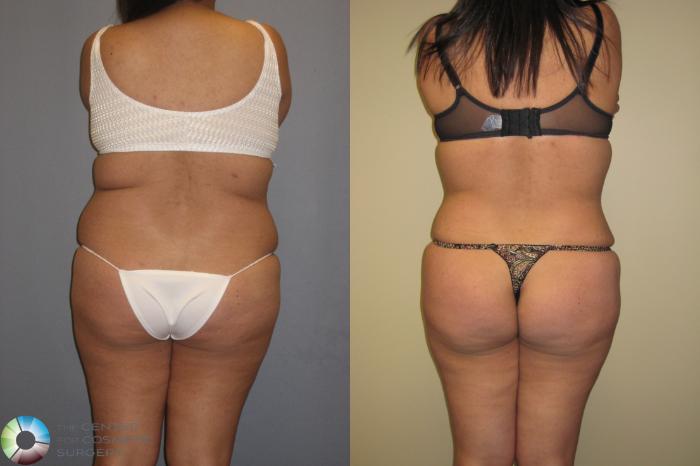 Before & After Tummy Tuck Case 160 View #4 View in Golden, CO
