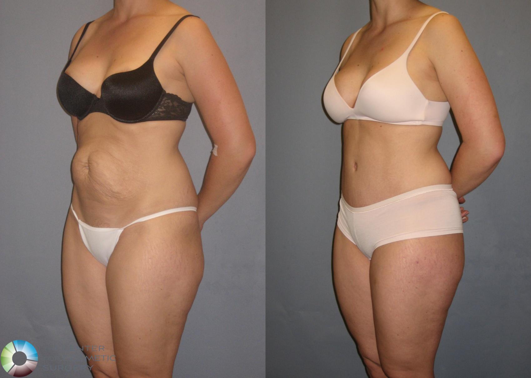 Before & After Tummy Tuck Case 162 View #1 in Denver and Colorado Springs, CO