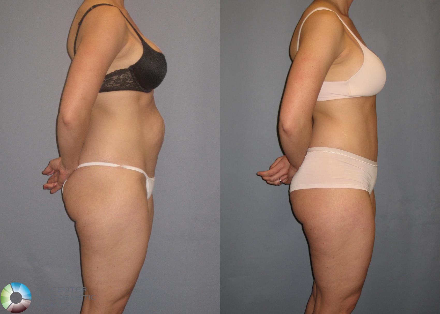 Before & After Tummy Tuck Case 162 View #2 View in Golden, CO