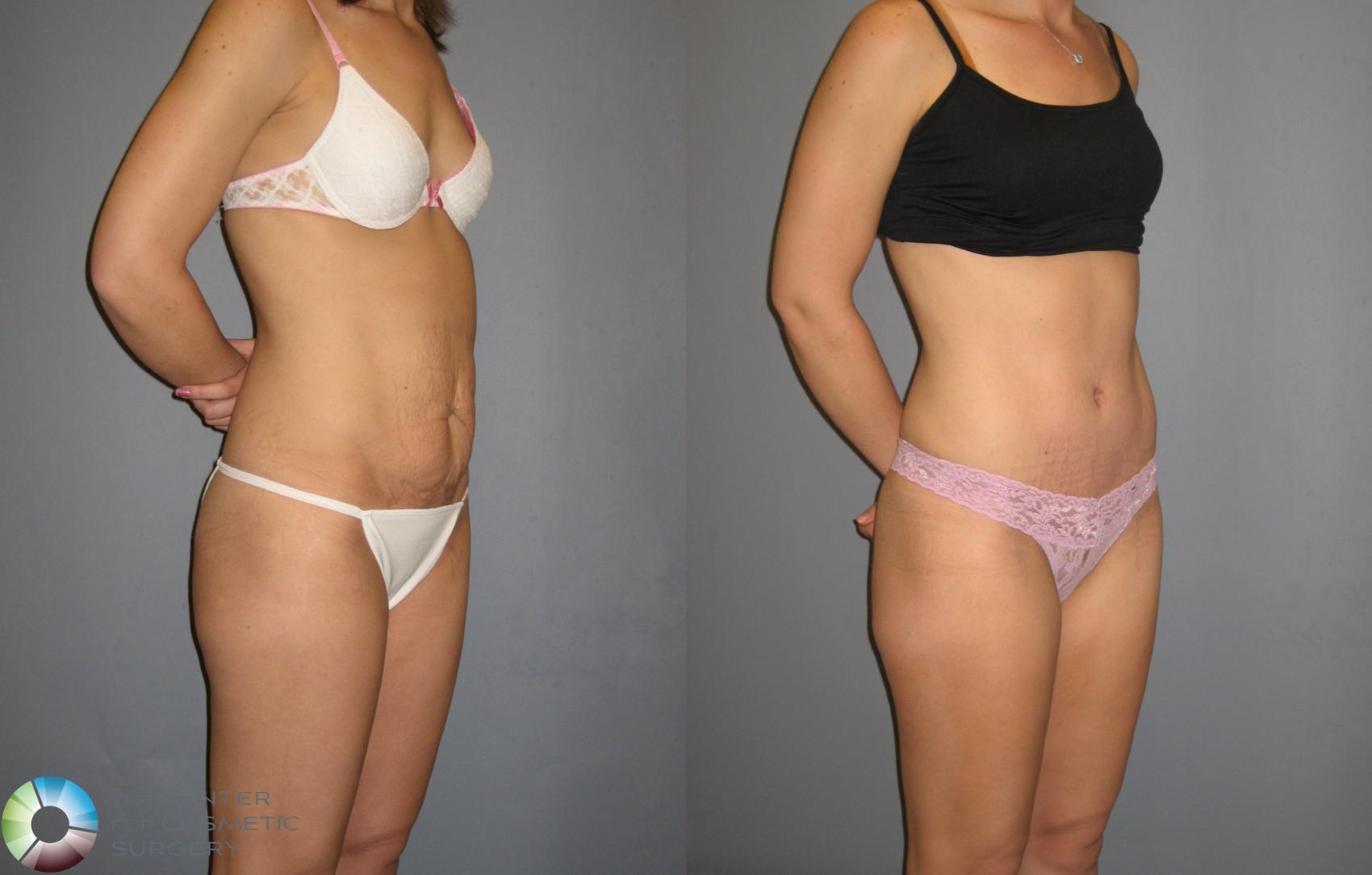 Before & After Tummy Tuck Case 189 View #1 View in Golden, CO