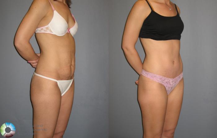 Before & After Tummy Tuck Case 189 View #1 in Denver and Colorado Springs, CO