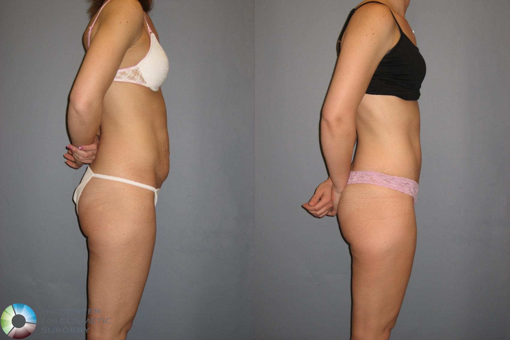 Before & After Tummy Tuck Case 189 View #2 View in Golden, CO