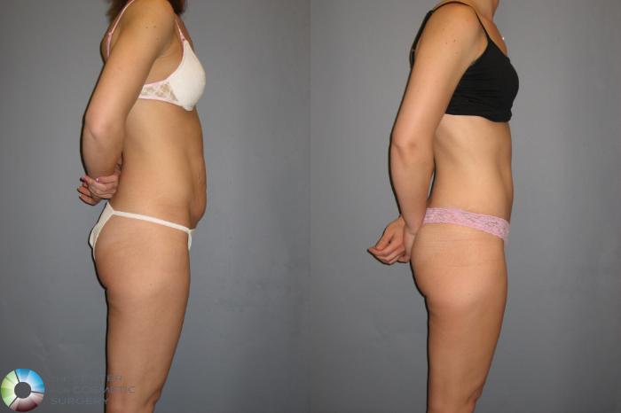 Tummy Tuck Before and After Pictures Case 11390, Denver, CO