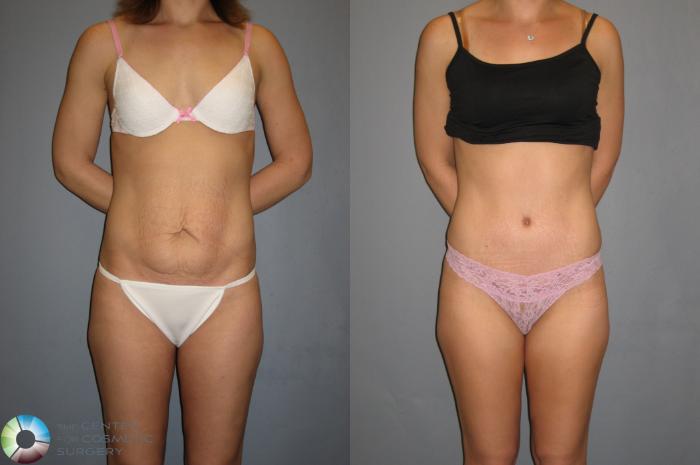 Before & After Tummy Tuck Case 189 View #3 in Denver and Colorado Springs, CO