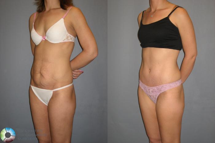 Before & After Tummy Tuck Case 189 View #4 in Denver and Colorado Springs, CO