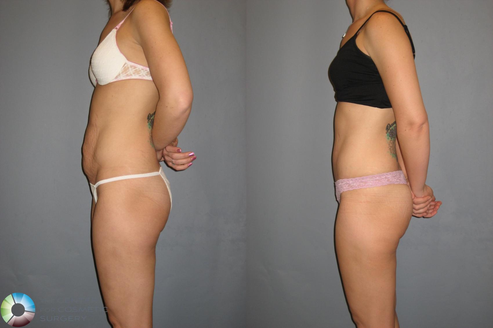 Before & After Tummy Tuck Case 189 View #5 View in Golden, CO