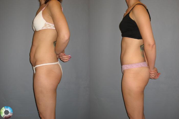 Before & After Tummy Tuck Case 189 View #5 in Denver and Colorado Springs, CO