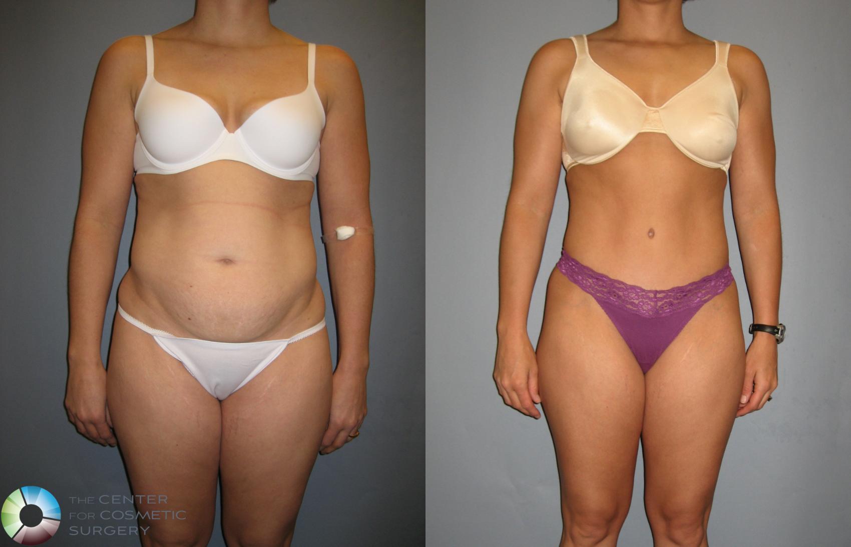 Before & After Tummy Tuck Case 190 View #1 in Denver and Colorado Springs, CO