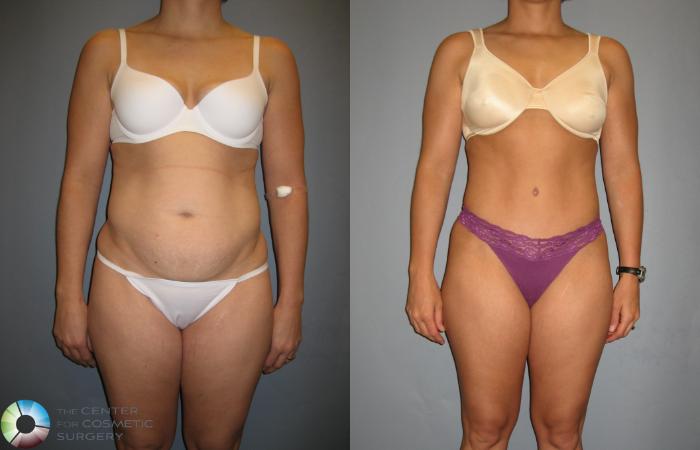 Before & After Tummy Tuck Case 190 View #1 View in Golden, CO