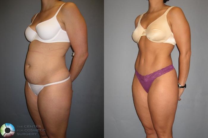 Before & After Tummy Tuck Case 190 View #2 View in Golden, CO