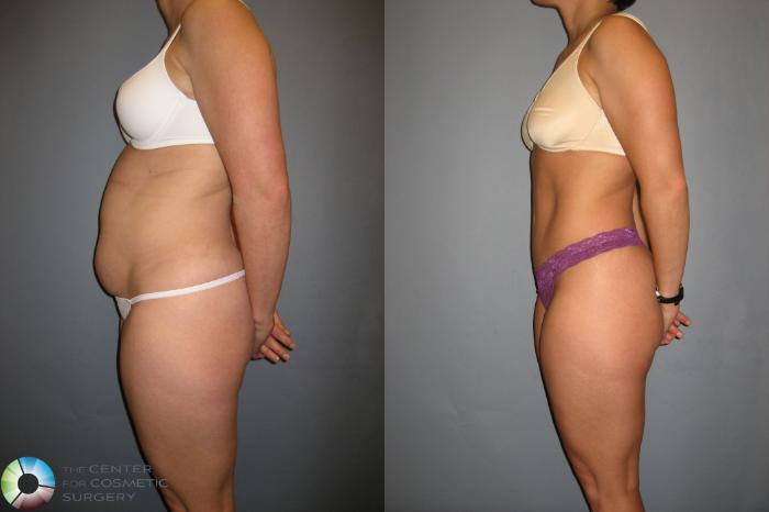 Before & After Tummy Tuck Case 190 View #3 View in Golden, CO
