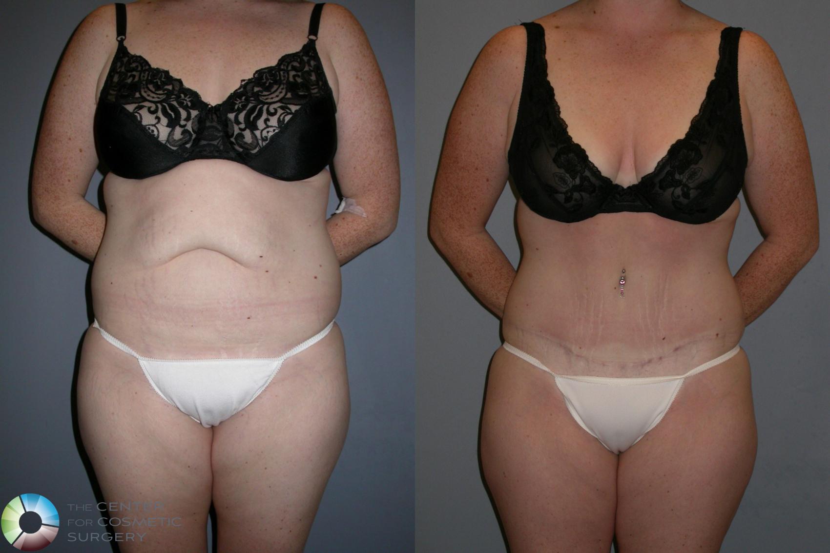 Before & After Tummy Tuck Case 191 View #1 in Denver and Colorado Springs, CO