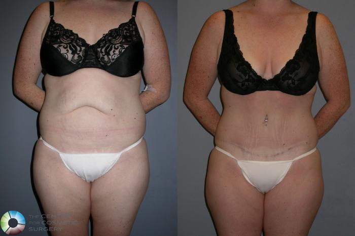 Before & After Tummy Tuck Case 191 View #1 View in Golden, CO