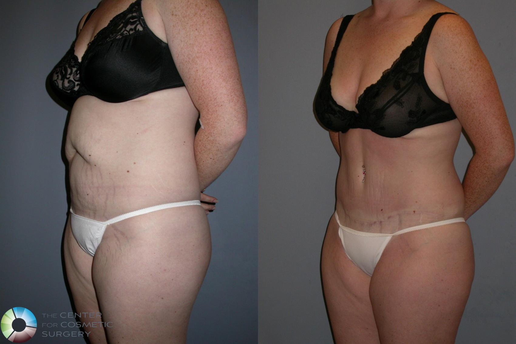 Before & After Tummy Tuck Case 191 View #2 in Denver and Colorado Springs, CO