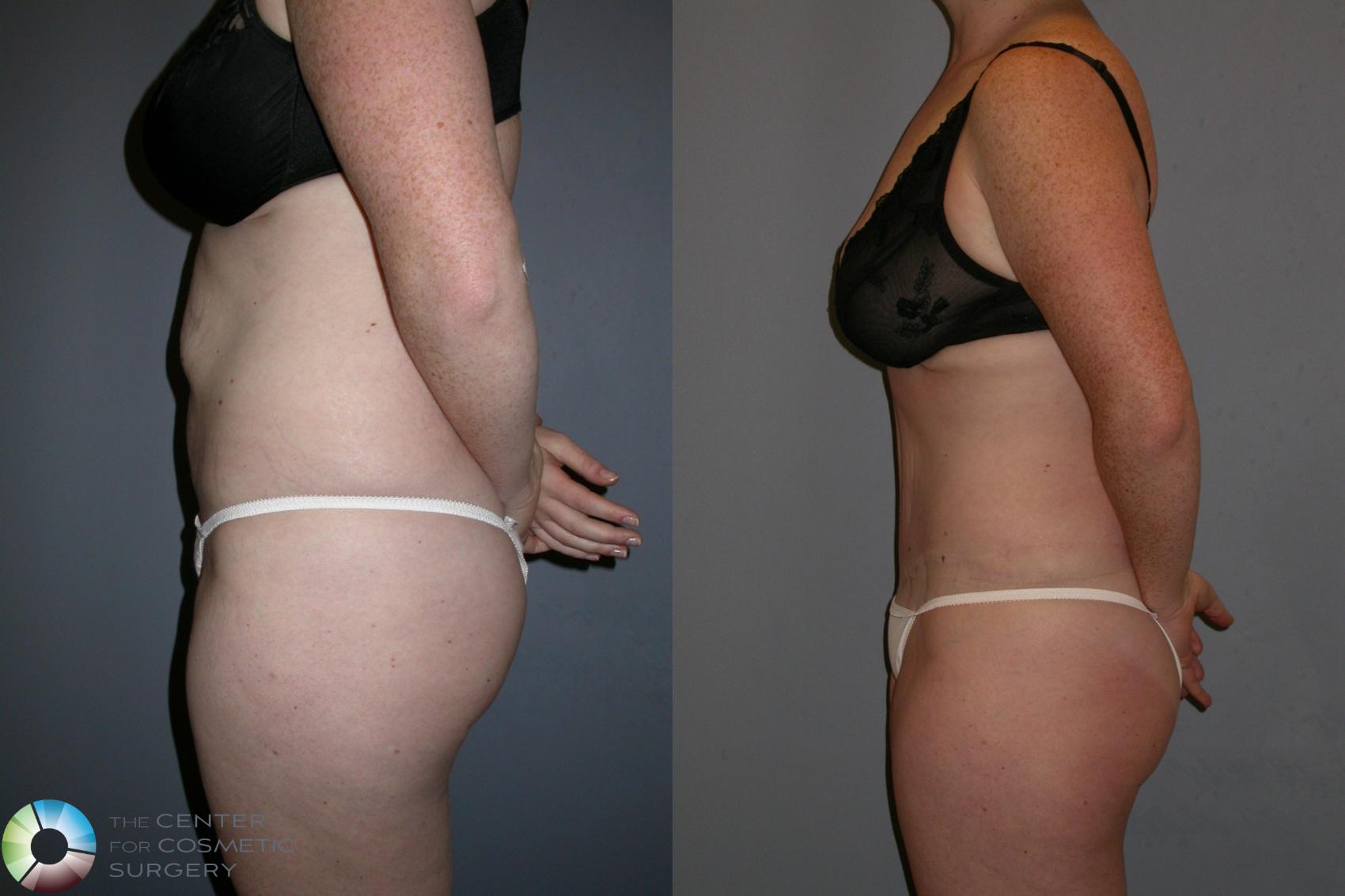 Before & After Tummy Tuck Case 191 View #3 in Denver and Colorado Springs, CO