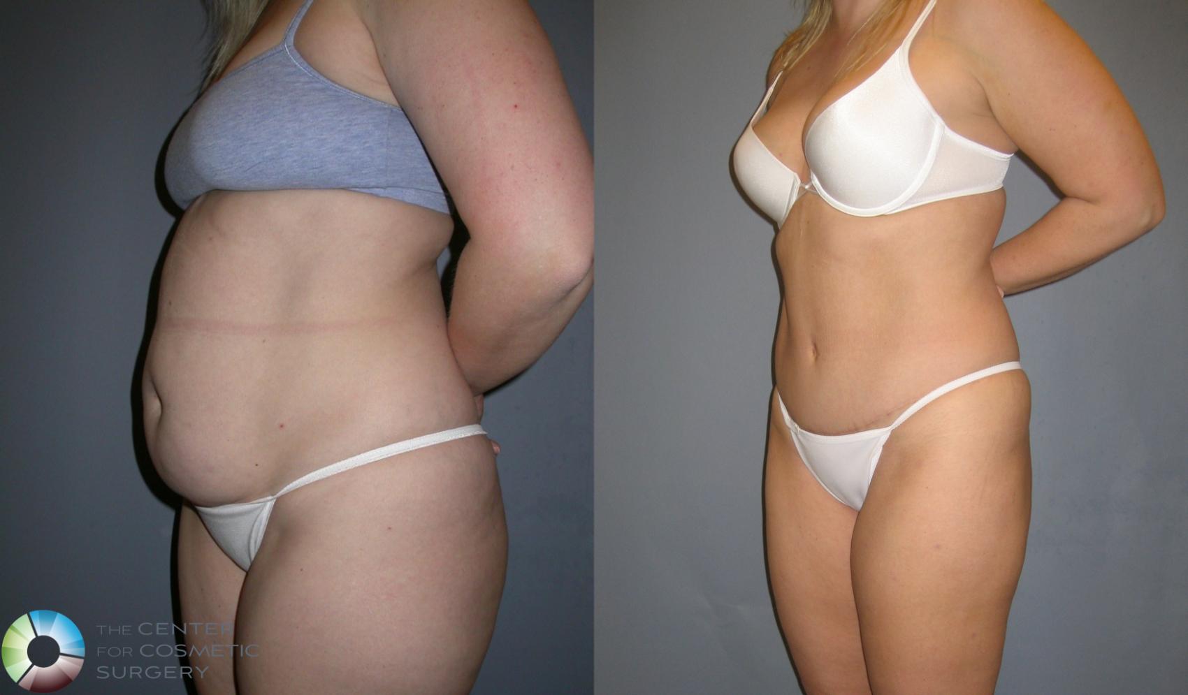 Before & After Tummy Tuck Case 192 View #2 View in Denver & Golden, CO