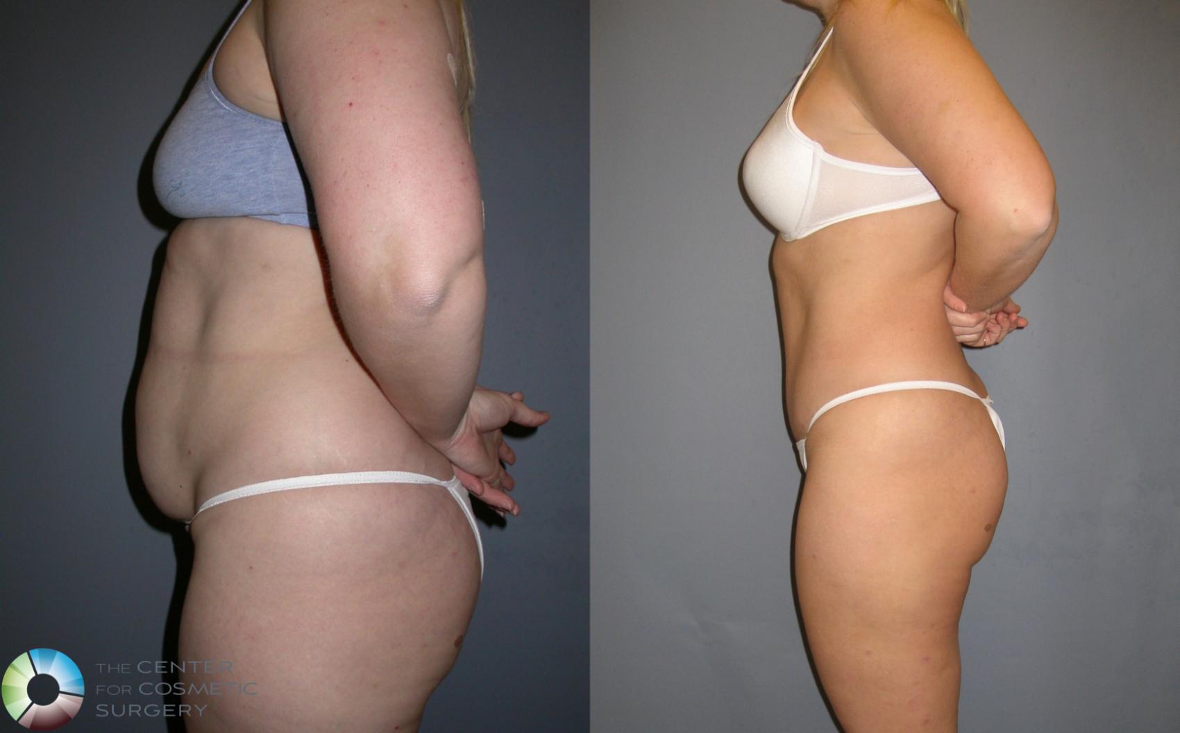Before & After Power-assisted Liposuction Case 192 View #3 View in Denver & Golden, CO