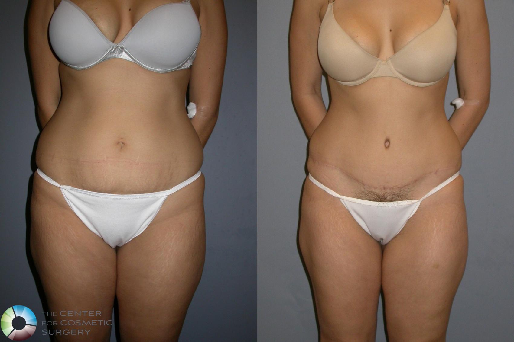 Before & After Tummy Tuck Case 193 View #1 in Denver and Colorado Springs, CO