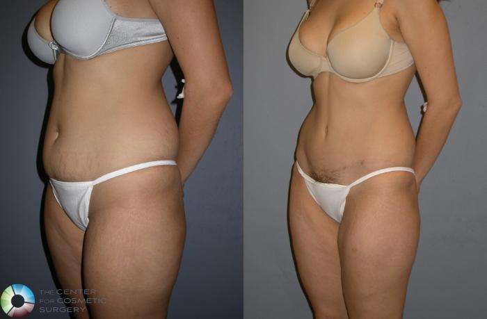 Before & After Tummy Tuck Case 193 View #2 in Denver and Colorado Springs, CO