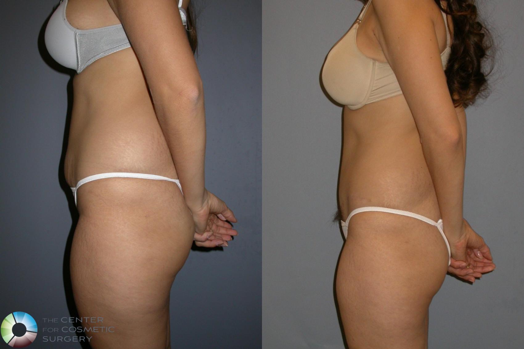 Before & After Tummy Tuck Case 193 View #3 in Denver and Colorado Springs, CO