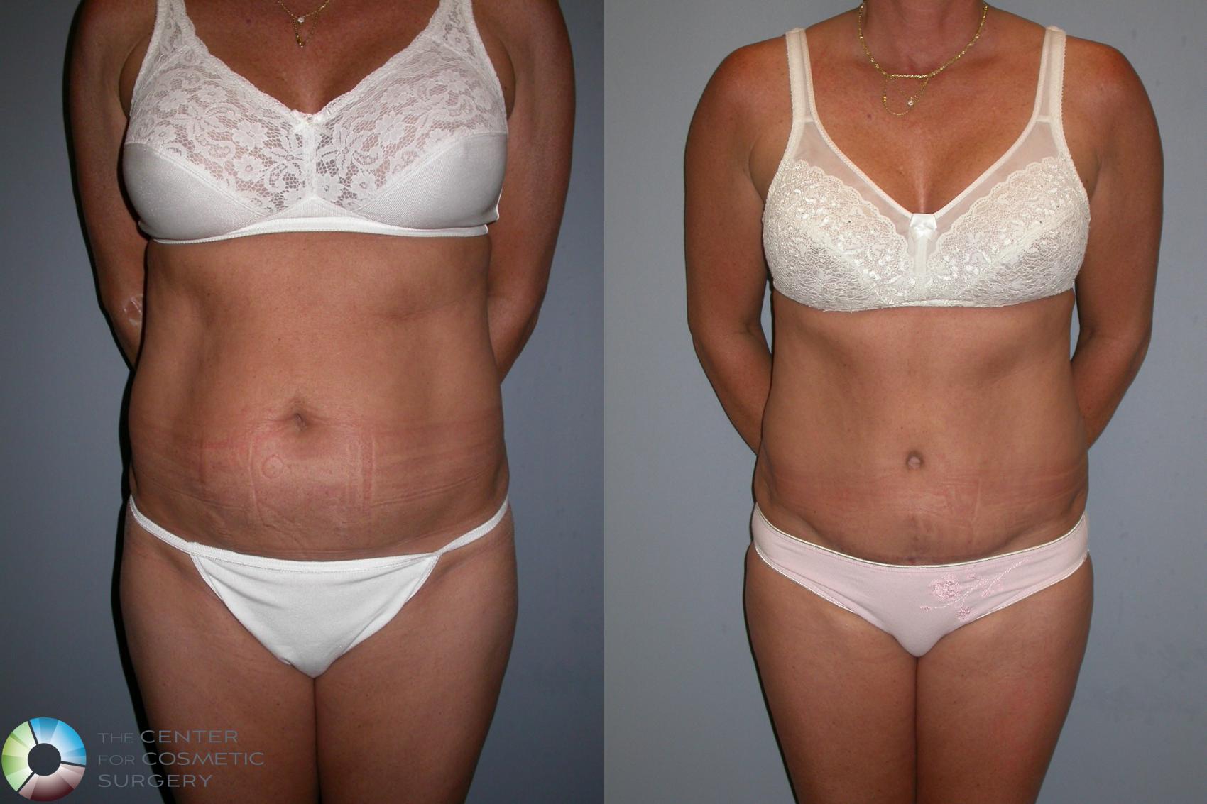 Before & After Tummy Tuck Case 194 View #1 in Denver and Colorado Springs, CO