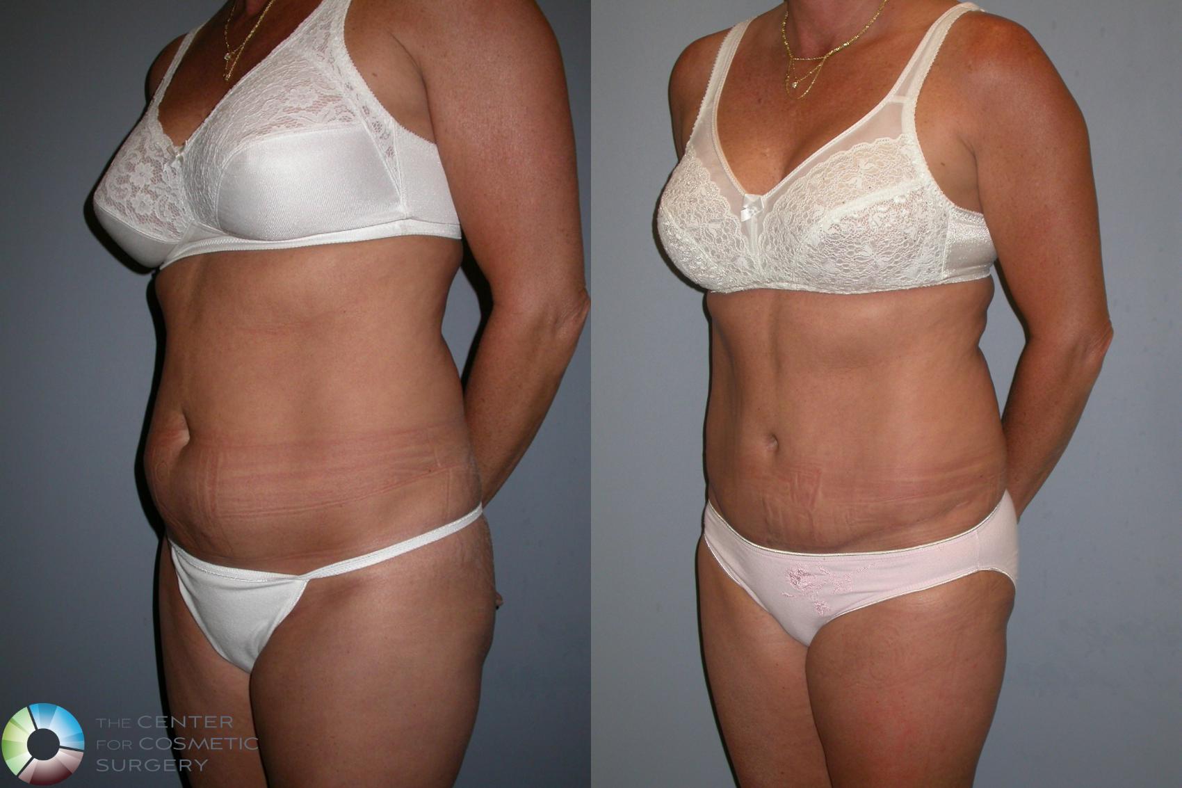 Before & After Tummy Tuck Case 194 View #2 View in Golden, CO