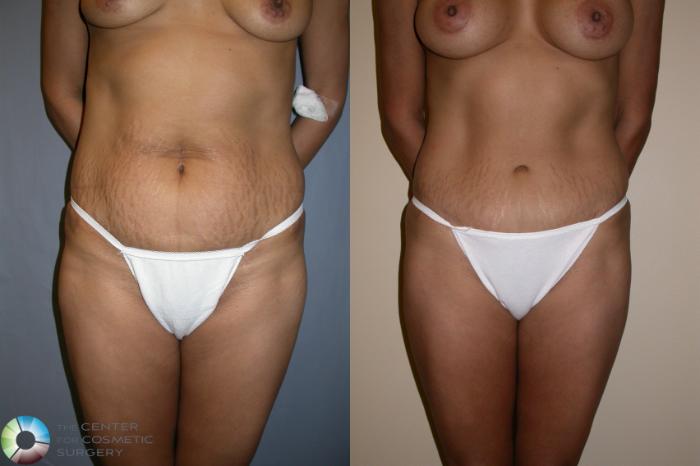 Before & After Tummy Tuck Case 195 View #1 View in Golden, CO