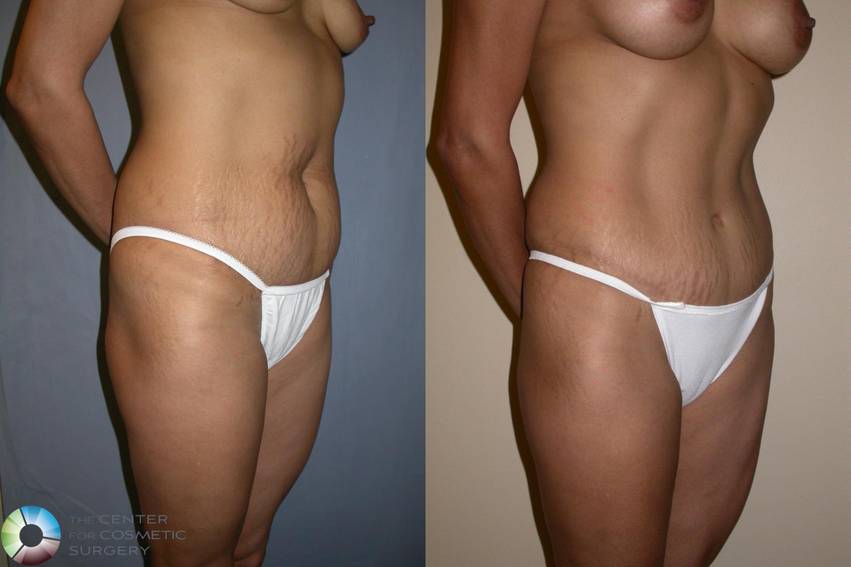 Before & After Tummy Tuck Case 195 View #2 View in Golden, CO