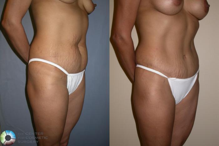 Before & After Tummy Tuck Case 195 View #2 in Denver, CO