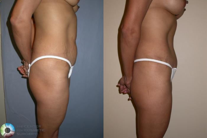 Before & After Tummy Tuck Case 195 View #3 in Denver, CO