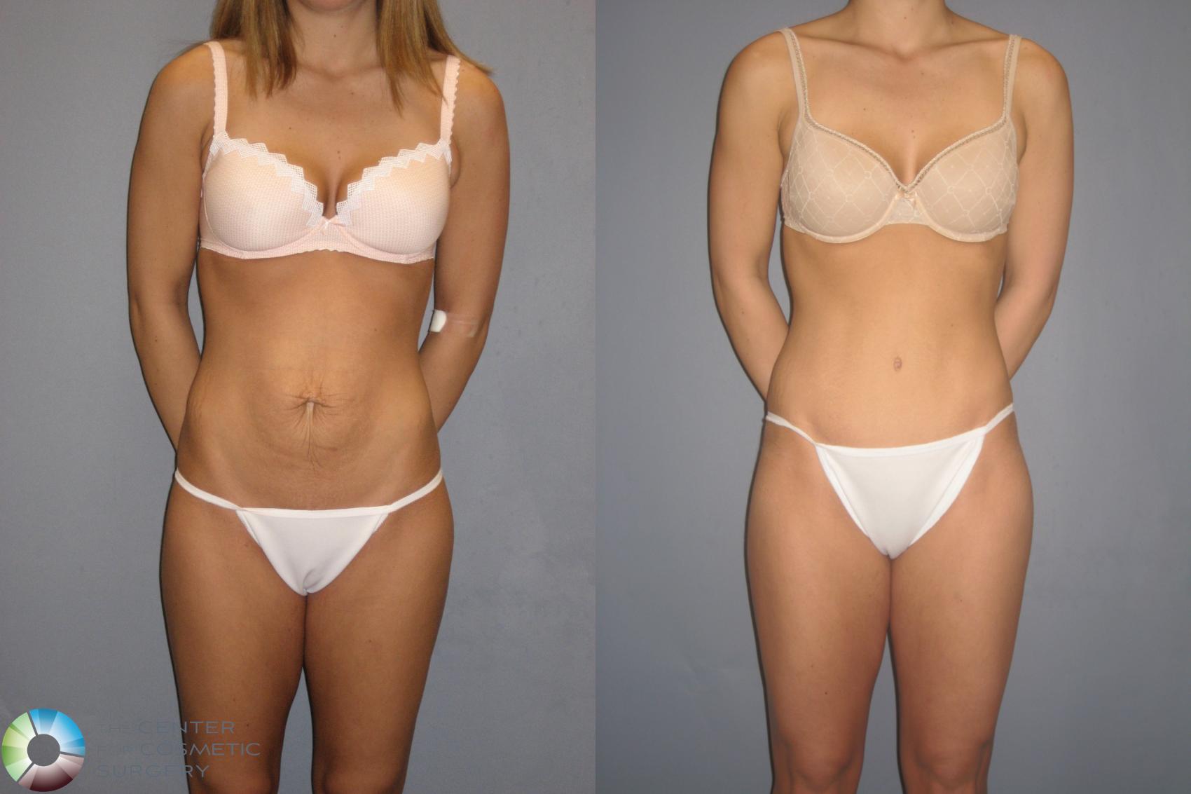 Before & After Tummy Tuck Case 197 View #1 View in Golden, CO
