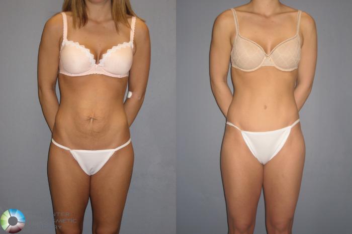 Before & After Tummy Tuck Case 197 View #1 View in Golden, CO