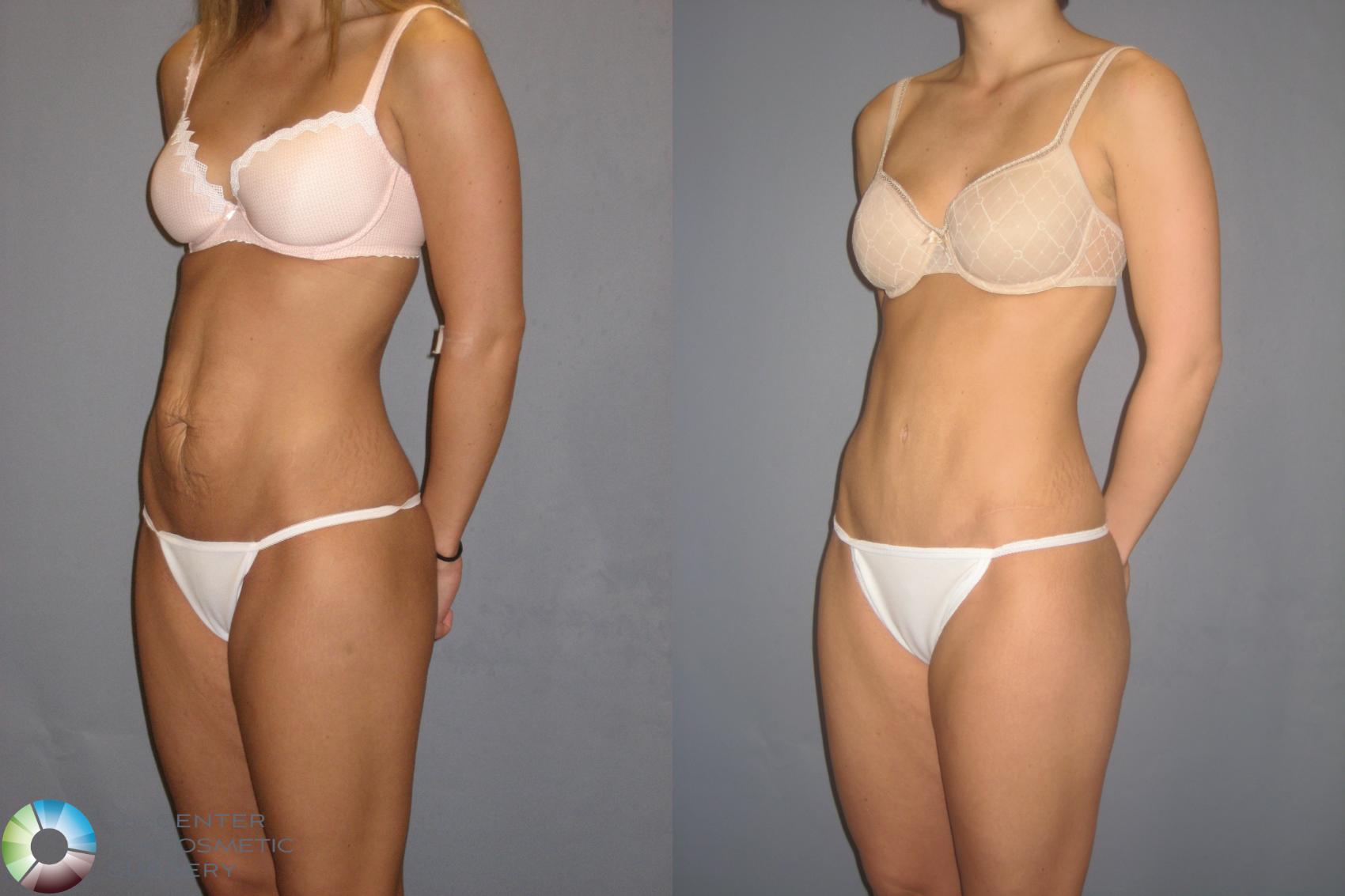 Before & After Tummy Tuck Case 197 View #2 View in Denver & Golden, CO