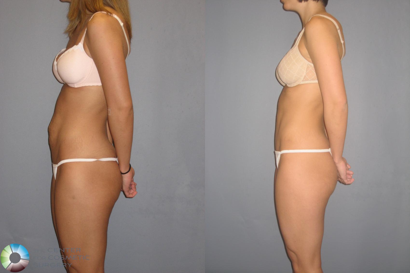 Before & After Tummy Tuck Case 197 View #3 View in Denver & Golden, CO