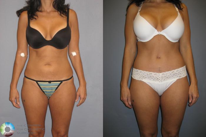 Before & After Tummy Tuck Case 198 View #1 View in Golden, CO