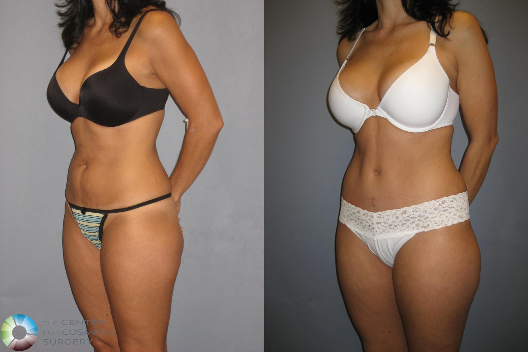 Before & After Tummy Tuck Case 198 View #2 View in Golden, CO