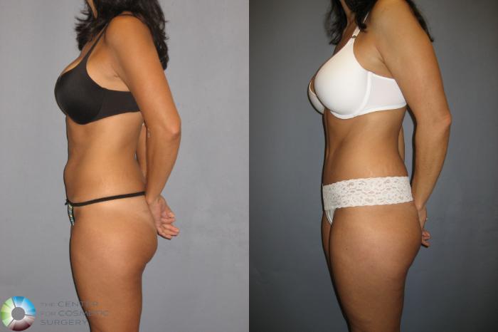 Before & After Tummy Tuck Case 198 View #3 View in Golden, CO