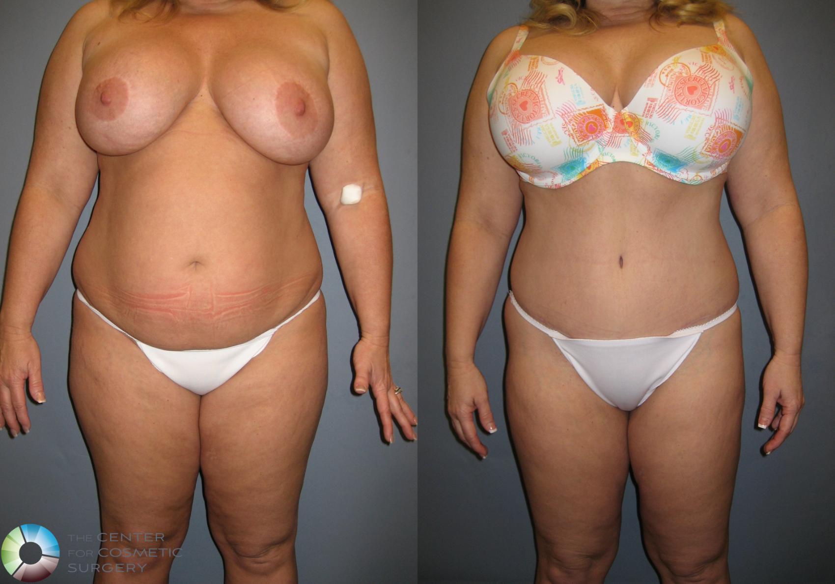 Before & After Tummy Tuck Case 199 View #1 View in Golden, CO
