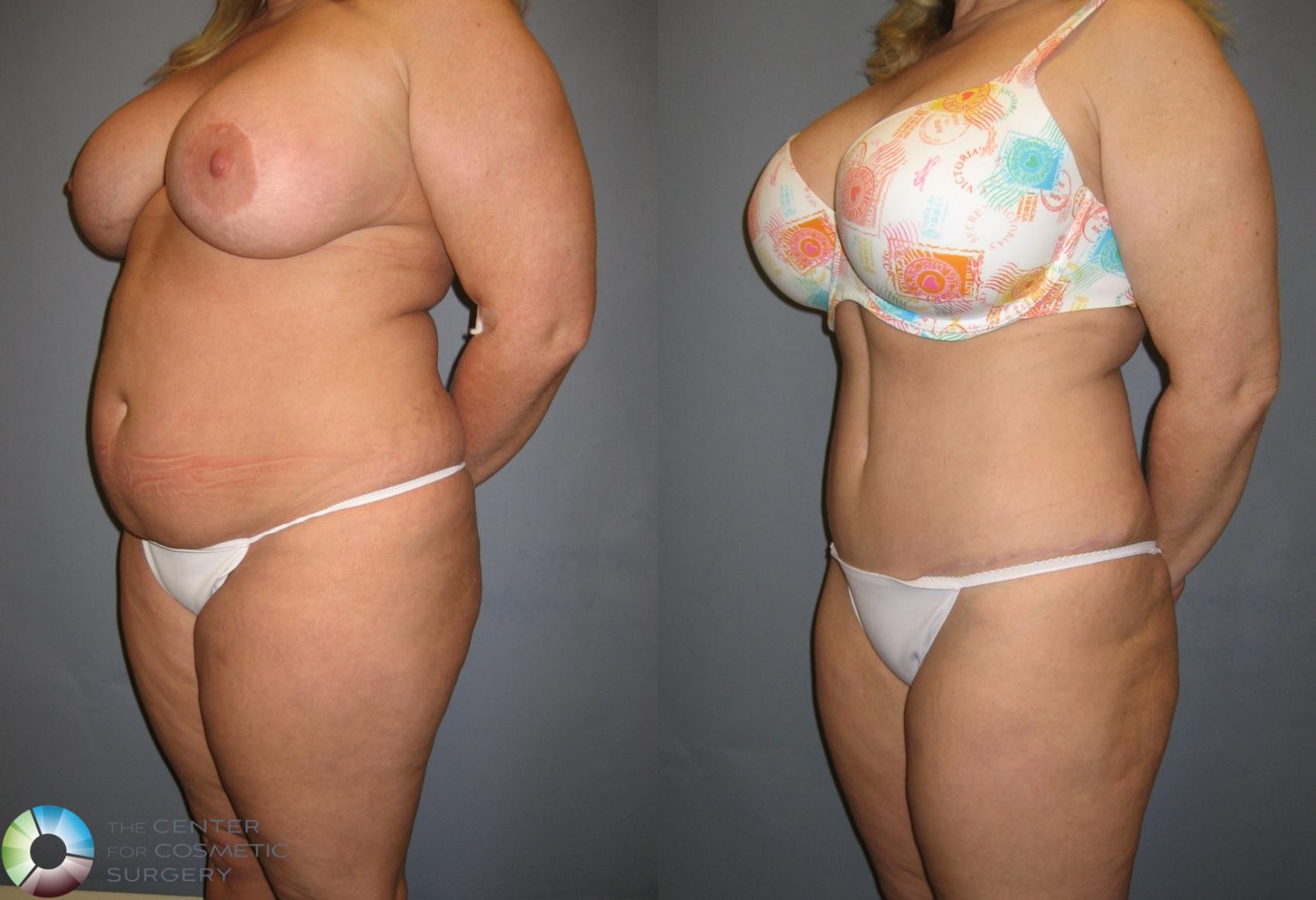 Before & After Tummy Tuck Case 199 View #2 in Denver and Colorado Springs, CO