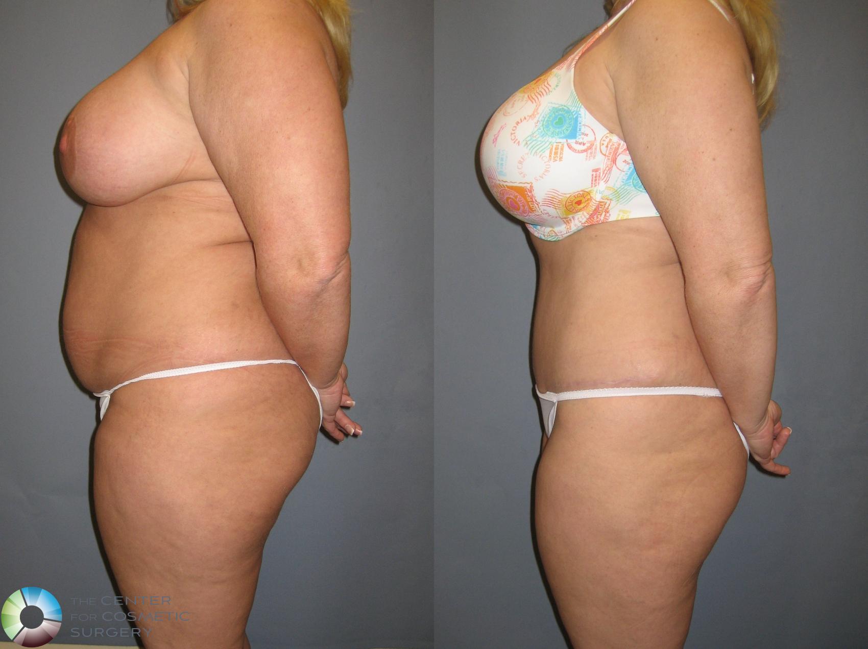 Before & After Tummy Tuck Case 199 View #3 in Denver and Colorado Springs, CO