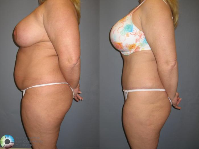 Before & After Tummy Tuck Case 199 View #3 View in Golden, CO