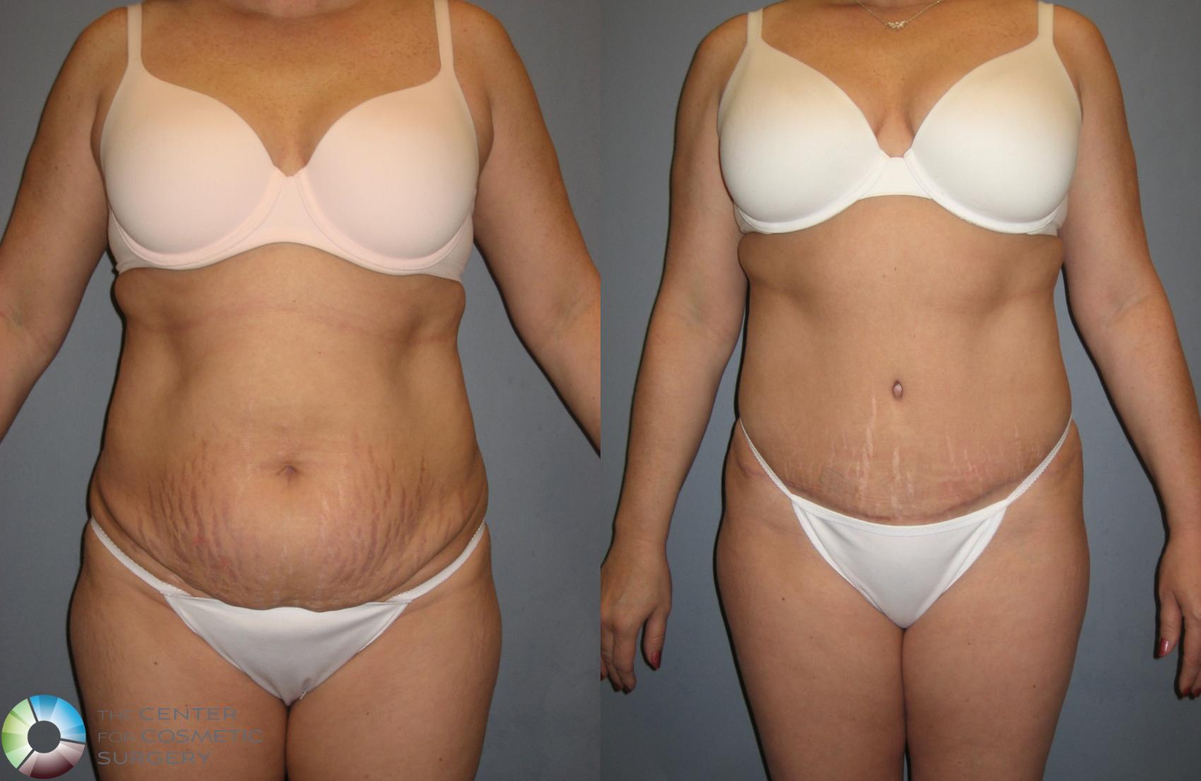 Before & After Tummy Tuck Case 201 View #1 in Denver and Colorado Springs, CO