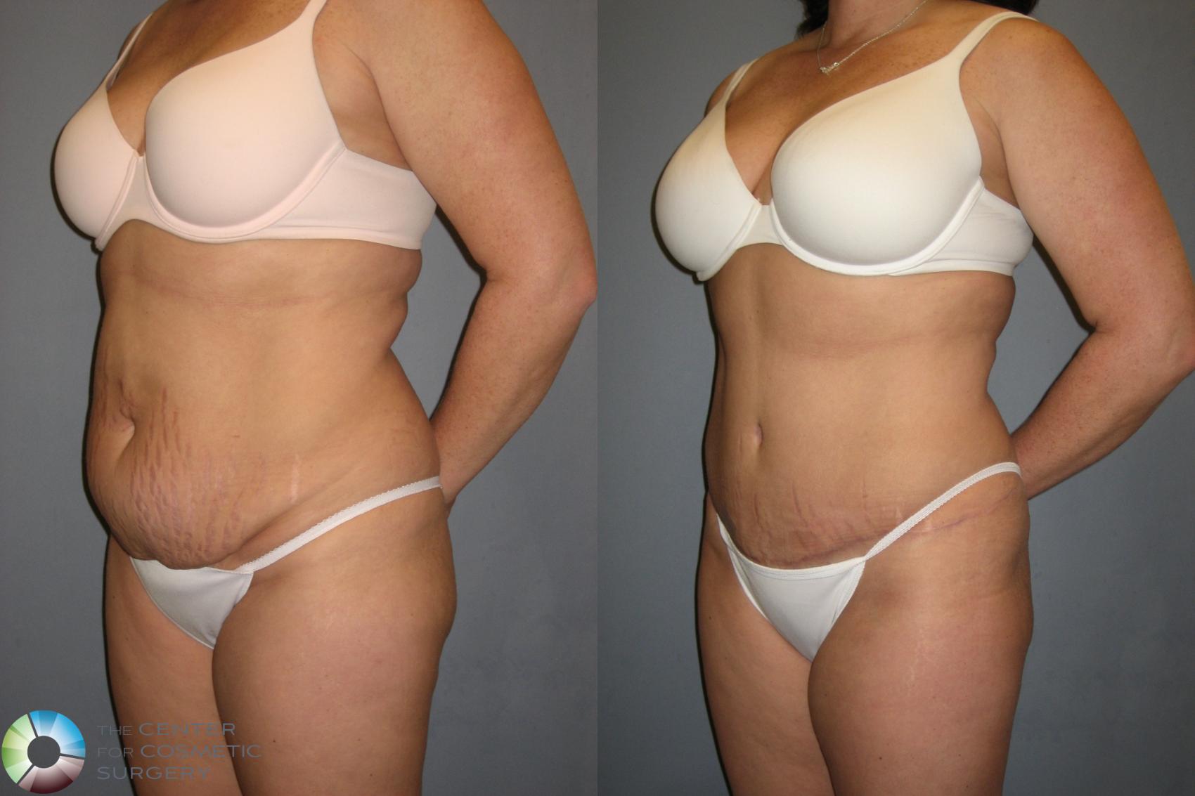 Before & After Tummy Tuck Case 201 View #2 View in Golden, CO