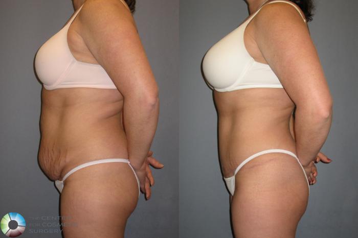Before & After Tummy Tuck Case 201 View #3 View in Golden, CO