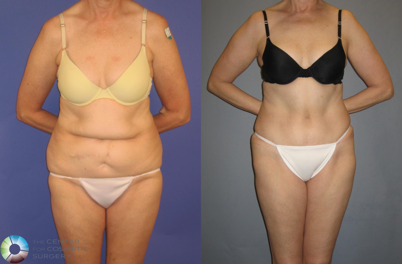 Before & After Tummy Tuck Case 202 View #1 in Denver and Colorado Springs, CO
