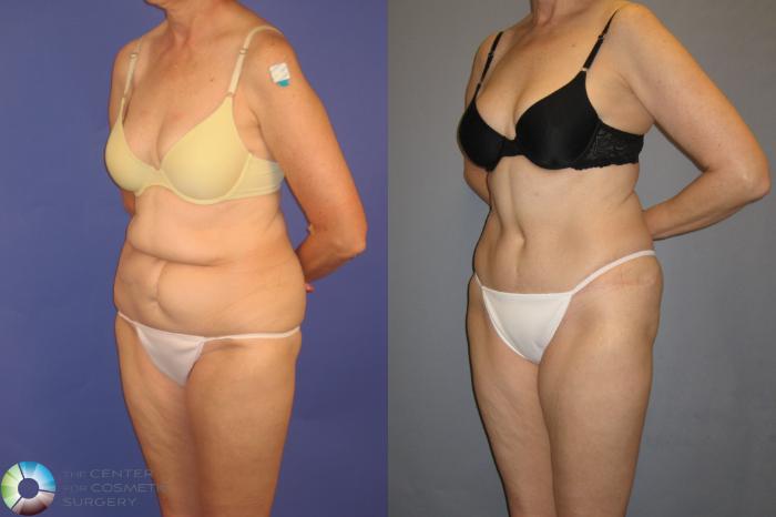 Before & After Tummy Tuck Case 202 View #2 in Denver and Colorado Springs, CO