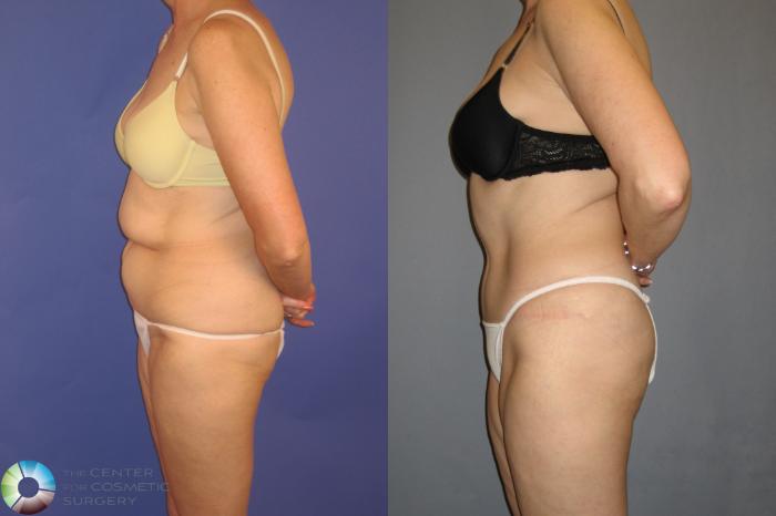 Before & After Tummy Tuck Case 202 View #3 in Denver and Colorado Springs, CO
