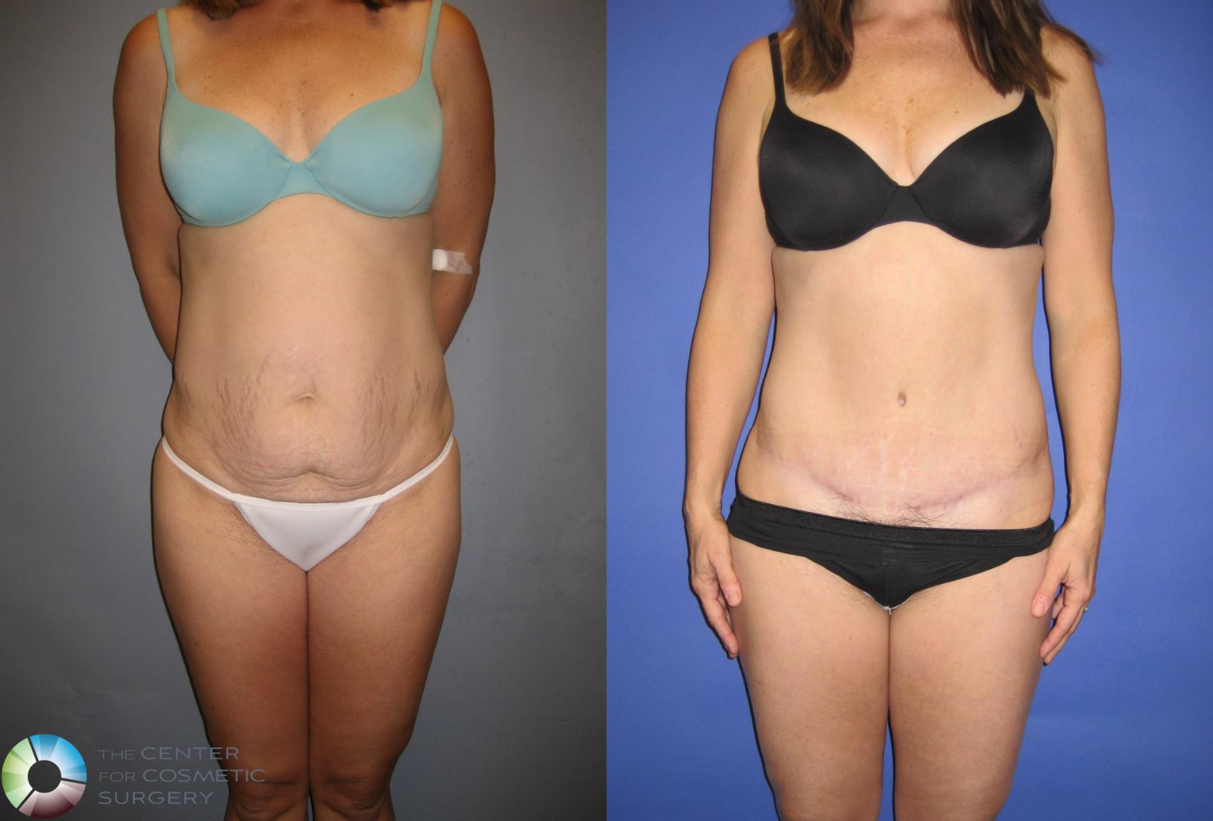 Before & After Tummy Tuck Case 203 View #1 in Denver and Colorado Springs, CO