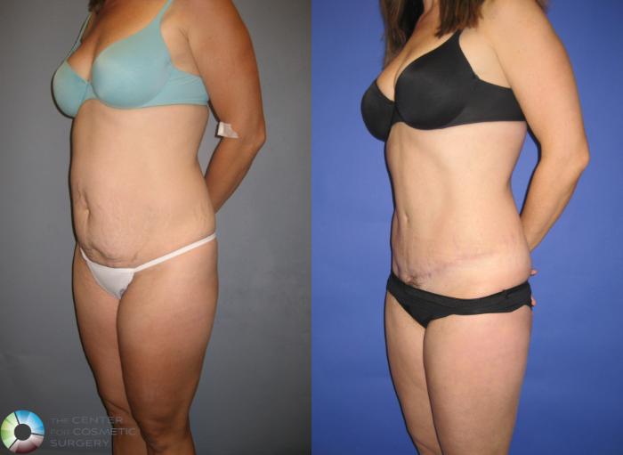 Before & After Tummy Tuck Case 203 View #2 View in Golden, CO